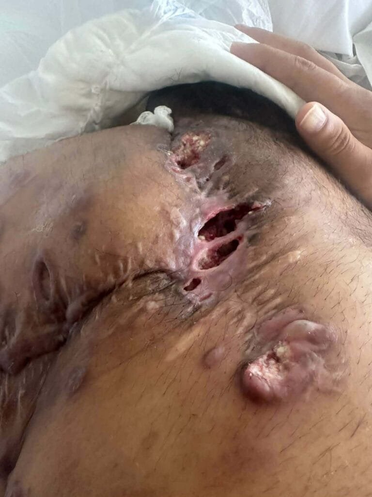 Conteúdo sensívelA imagem a seguir expõe os efeitos do carcinoma espinocelular, um tipo agressivo de câncer de pele que pode evoluir rapidamente, causar feridas profundas e se espalhar para outras partes do corpo (metástase), exigindo tratamentos intensivos e urgentes. Mostrar essa realidade é essencial para conscientizar sobre a gravidade da doença e a importância do diagnóstico e tratamento adequados.